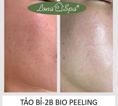 tao-bi-2b-bio-peeling